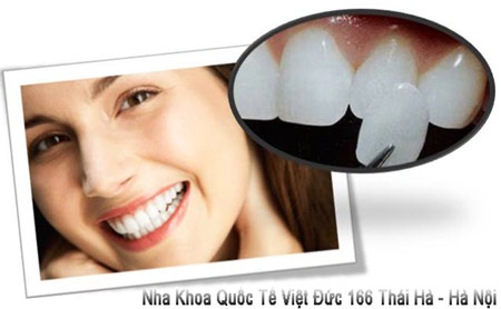 Tái tạo nụ cười với răng sứ Veneer - 1 Nụ cười rạng rỡ hơn với răng sứ Veneer