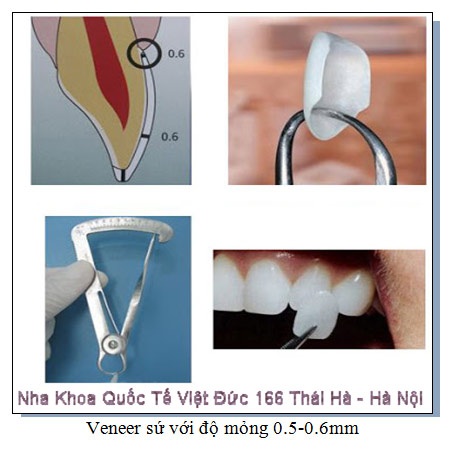 Tái tạo nụ cười với răng sứ Veneer - 2 Việc mài răng ít là ưu điểm nổi trội của kỹ thuật làm Veneer, trung bình khi