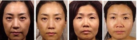 Trẻ đẹp da với tế bào gốc tự thân - 1 Trước và sau khi chích tế bào gốc