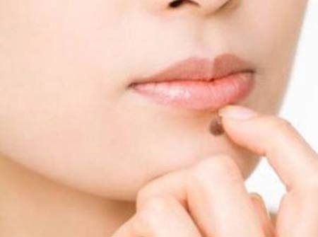 Họa khó lường vì tự tẩy nốt ruồi - 1 Họa khó lường vì tự tẩy nốt ruồi