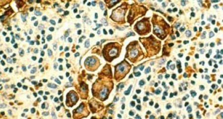 Phát hiện protein gây ung thư di căn - 1 Các tế bào ung thư vú có kích thước lớn hơn tế bào thường tới 400 lần