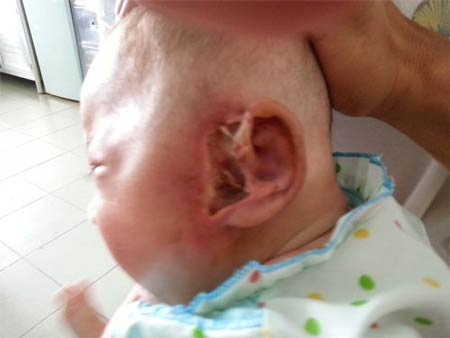 Bé 5 tháng tuổi bị giòi ăn mất ống tai - 1 Tổn thương tai do giòi ăn