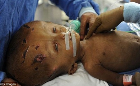 Cứu sống bé gái đầu phình to bất thường - 2 Bé gái nằm viện trong quá trình điều trị