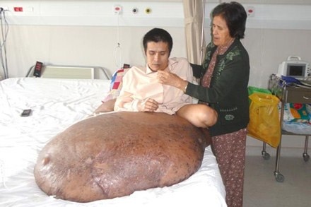 Phép màu của chàng trai có khối u 90kg - 1 Khối u khổng lồ của Hải trước khi phẫu thuật