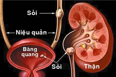 Bệnh sỏi thận: Chớ coi thường - 1 (Ảnh minh họa)