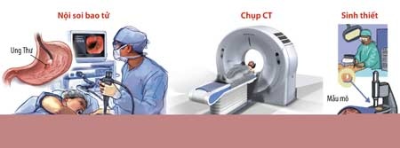 Làm thế nào chẩn đoán bệnh ung thư? - 1 Làm thế nào chẩn đoán bệnh ung thư?