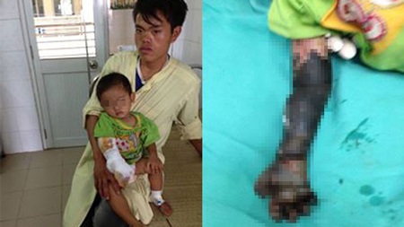 Cháu bé bị hoại tử cánh tay do cha mẹ đắp tro lên vết bỏng