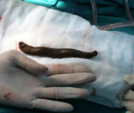 Gắp con đỉa 20cm trong bàng quang thiếu niên - 1 Con đỉa được gắp ra từ bàng quang của bé L.