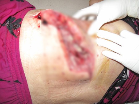 Nguy kịch vì cắt lễ thiếu vệ sinh - 1 Vùng bị khoét bỏ do nhiễm trùng hoại thư sinh hơi