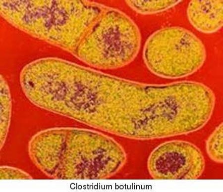 Các biểu hiện khi ngộ độc khuẩn gây liệt cơ