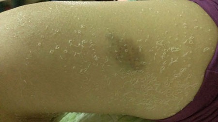 Tắm trắng tại nhà, cô gái bị "lột da" loang lổ toàn thân - 2 Da bị lột, khắp người loang lổ.
