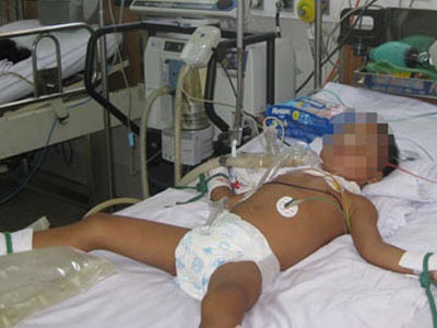 Bé 3 tuổi thủng ruột do nuốt nam châm dính sắt