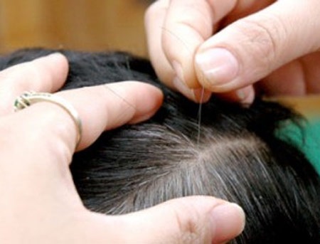 Phán đoán sức khỏe qua vị trí tóc bạc mọc - 1 Tóc bạc ở trán – tỳ, dạ dày rối loạn