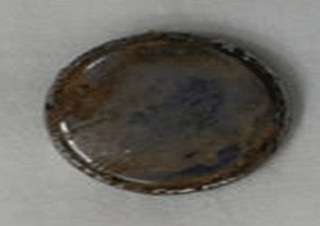 Cục pin hoen gỉ nằm trong lồng ngực bé 10 tháng tuổi - 1 Cục pin hoen gỉ được lấy ra từ lồng ngực bé 10 tháng tuổi