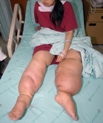 Màn lưới giúp giảm nguy cơ mắc phù chân voi - 1 Màn lưới giúp giảm nguy cơ mắc phù chân voi