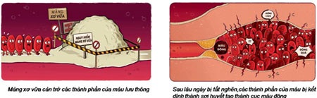 Tai biến cao huyết áp bắt nguồn từ đâu? - 2 Quá trình hình thành cục máu đông