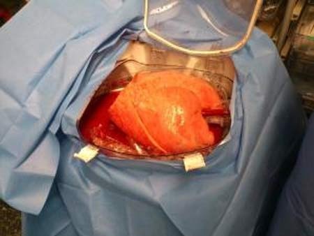 Lá phổi được bảo quản trước khi chờ ghép