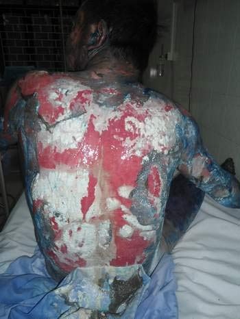 Da toàn thân bệnh nhân H. bị chợt loét, rỉ dịch khi nhập viện