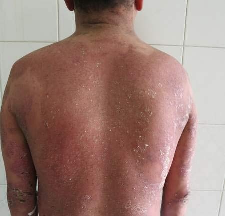 Anh H. Sau khi điều trị