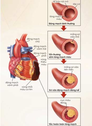 Rối loạn mỡ máu - sát thủ âm thầm gây nhồi máu cơ tim - 1 Sự lắng đọng cholesterol trong lòng mạch khiến mảng xơ vữa xuất hiện, gây nên NMCT.