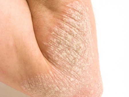 Những hiểu lầm về bệnh vẩy nến - 1 1/3 người mắc là do di truyền