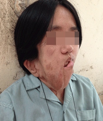 Cô gái mang khuôn mặt biến dạng gần 20 năm vì khối u xơ - 1 Cô gái mang khuôn mặt biến dạng gần 20 năm vì khối u xơ