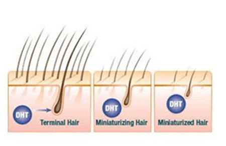 DHT: Thủ phạm của 80% trường hợp rụng tóc, hói đầu - 1 Chú thích ảnh: DHT làm nang tóc teo nhỏ, tóc yếu và dễ rụng
