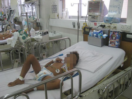 Bị dằm đâm vào chân, một bệnh nhi bị uốn ván nặng - 1 Bị dằm đâm vào chân, một bệnh nhi bị uốn ván nặng