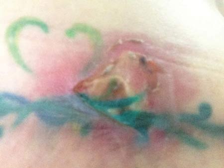 Đi mát-xa tan mỡ, bị nhiễm trùng vùng bụng - 2 Vết sẹo do mát-xa bụng