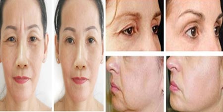 Căng da mặt bằng chỉ với bác sỹ Hàn Quốc - 3 Kết quả sau khi thực hiện căng da mặt tại Thẩm mỹ Hồng Ngọc