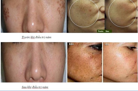 Trị nám da hiệu quả bằng công nghệ mới Spectra Laser - 3 Kết quả trước và sau điều trị nám da tại Thẩm mỹ Hồng Ngọc