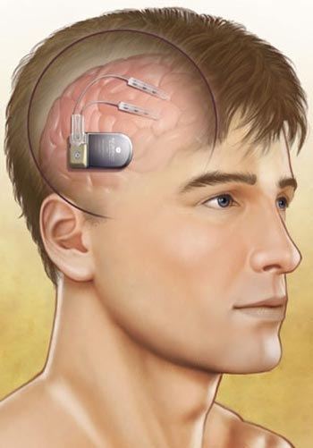 Thiết bị chặn đứng cơn động kinh