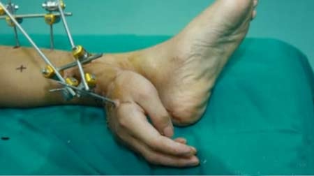 Ghép tay phải vào chân trái để cứu bàn tay