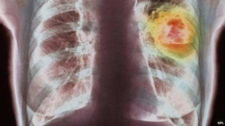 Thế giới: Tỉ lệ mắc ung thư tăng mạnh - 1 Các dữ liệu vào năm