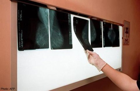 Cảnh báo tai biến khi dùng thuốc trị ung thư Xeloda - 1 Cảnh báo tai biến khi dùng thuốc trị ung thư Xeloda