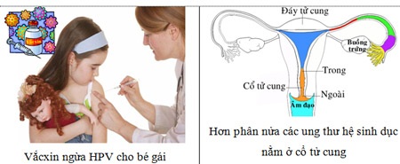 Ung thư cổ tử cung: Chuyện của các bà mẹ - 1 Xuất huyết âm đạo bất thường – Nên đi khám ngay