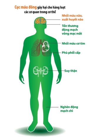 Biến chứng cao huyết áp - 80% là do cục máu đông - 2 Các biến chứng CMĐ có thể gây ra cho cơ thể.