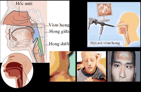 Ung thư vòm họng: Gặp bệnh trễ, đừng bi quan - 1 Ung thư vòm họng: Gặp bệnh trễ, đừng bi quan