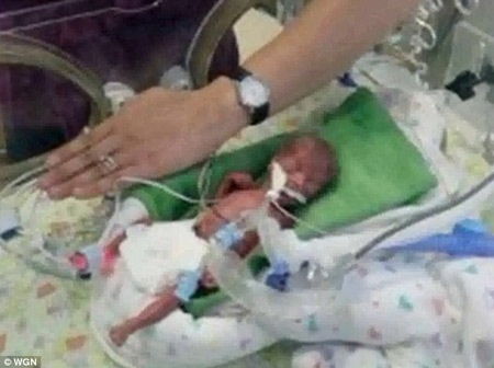 Cứu thành công “em bé thần kỳ” 17 tuần tuổi - 1 Quá nhỏ: Meghan chỉ dài có 20cm; trong khi trẻ sơ sinh trung bình dài từ 35 đến 50cm