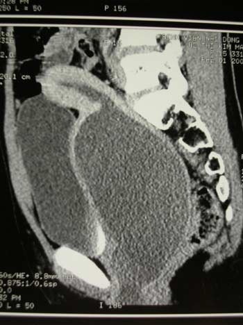 Tạo hình âm đạo cho bé gái