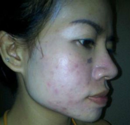 Làm đẹp “tốc hành” đón Tết: Coi chừng tiền mất, tật mang - 5 Hậu quả tự tẩy trắng tại gia