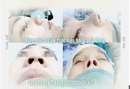 Nâng mũi cấu trúc chức năng kiểu Hàn Quốc - 6 Hình ảnh