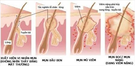 Mụn trứng cá: Cần trị cả trong lẫn ngoài - 2 Nguyên nhân sinh mụn trứng cá