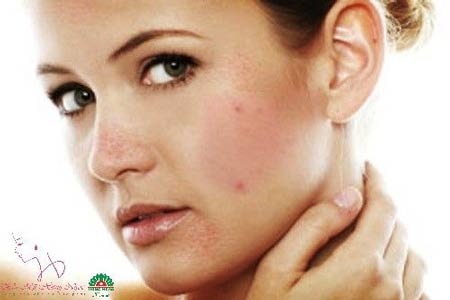 Trị mụn hiệu quả bằng công nghệ Healite - 1 Mụn thường xuất hiện trên da do rối loạn chức năng bài tiết