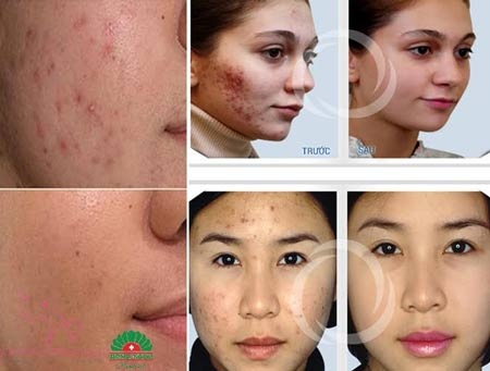 Trị mụn hiệu quả bằng công nghệ Healite - 3 Kết quả vượt trội sau điều trị mụn