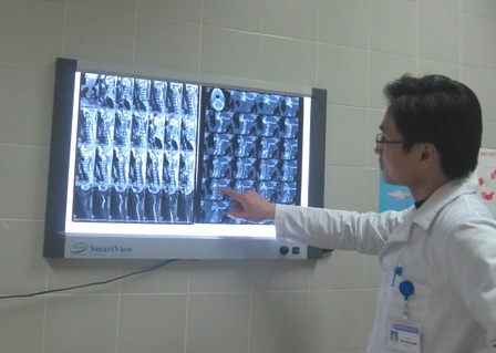Liệt dần sau khi đau cổ, tê tay và vai - 1 Những điểm bất thường trên cột sống cổ được BS Trung chỉ ra