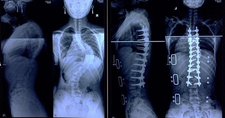 Khám tư vấn miễn phí bệnh lý cột sống cho trẻ em