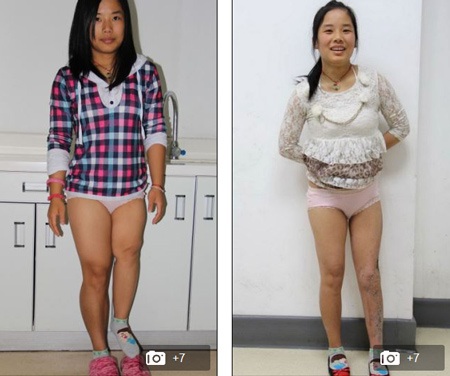 Bộ khung kim loại được lắp vào chân trái để kéo chân ra từ từ.