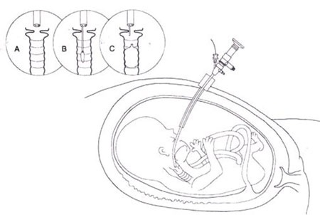 Bé Hope hiện tại
