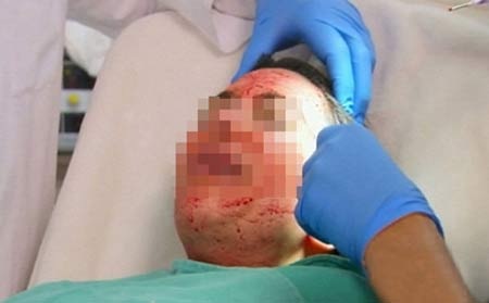 Tiếp cận công nghệ kinh rợn dùng máu người tái tạo da ở Sài Gòn - 1 Sau li tâm, phần huyết tương tiểu cầu (phần ở giữa) sẽ được
tiêm vào da. Ảnh T.G
